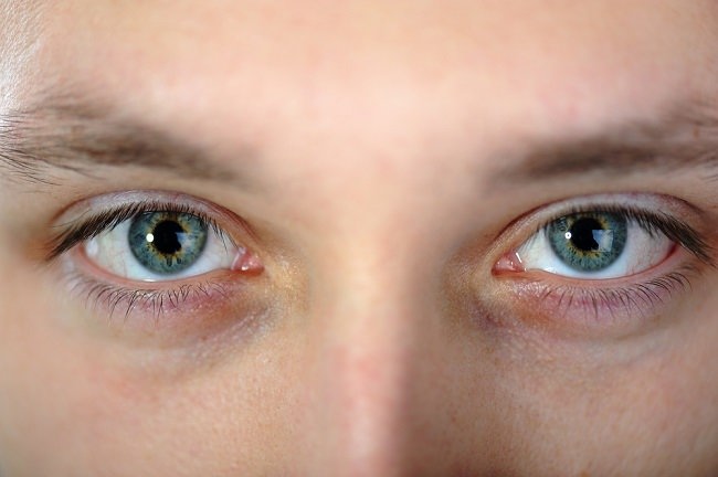 Sindrom Horner Gejala Penyebab Dan Mengobati Alodokter