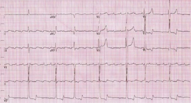 atrial flutter causes during pregnancy atrial flutter causes during pregnancy