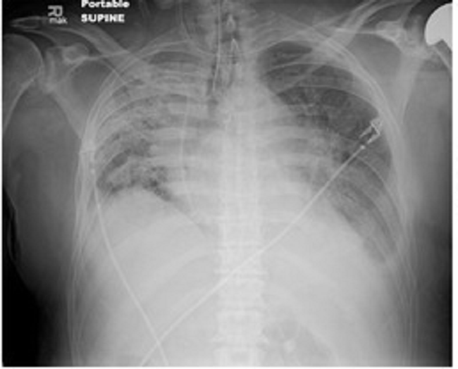 Gambar 1. Rontgen dada hemothorax (Sumber : Openi, 2016)