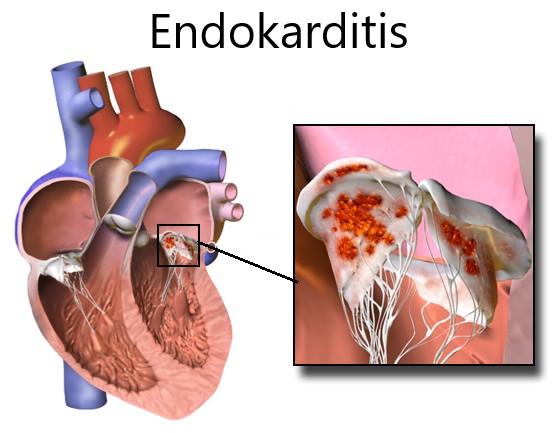 Diagnosis Endokarditis Alomedika