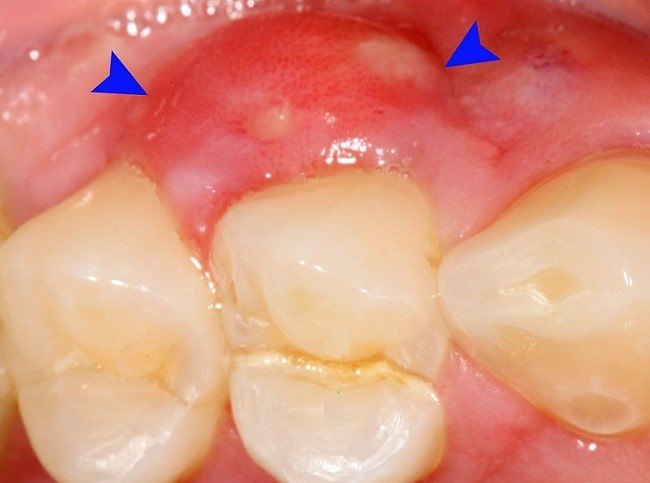 Sumber: Coronation Dental Specialty Group, Wikimedia commons, 2014.