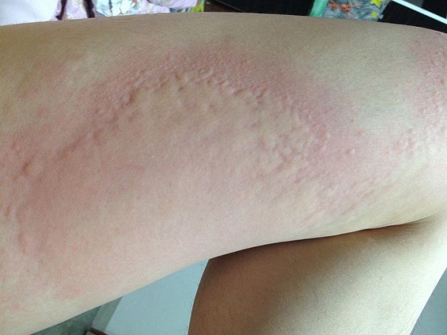 Patofisiologi Urtikaria - Alomedika