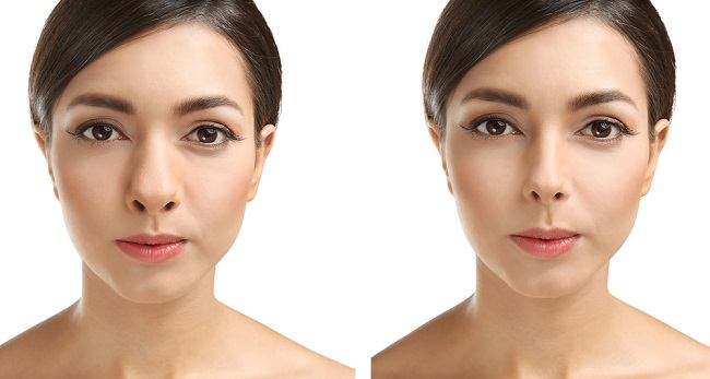 Operasi Memancungkan Hidung