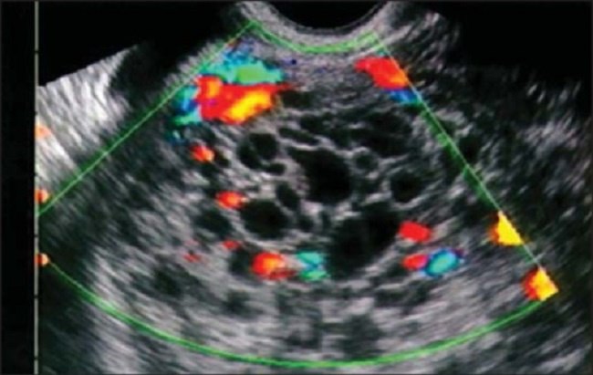 Mola Hidatidosa - patofisiologi, diagnosis 