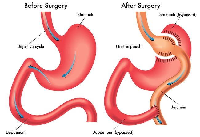 untung-rugi-roux-en-y-gastric-bypass-alomedika