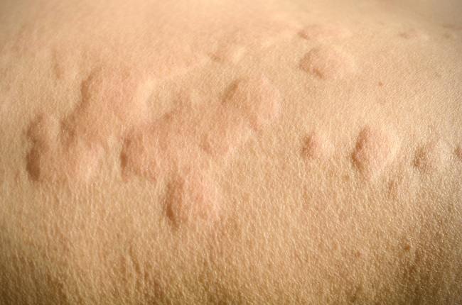 Hives: Symptoms, Causes and How to Overcome It