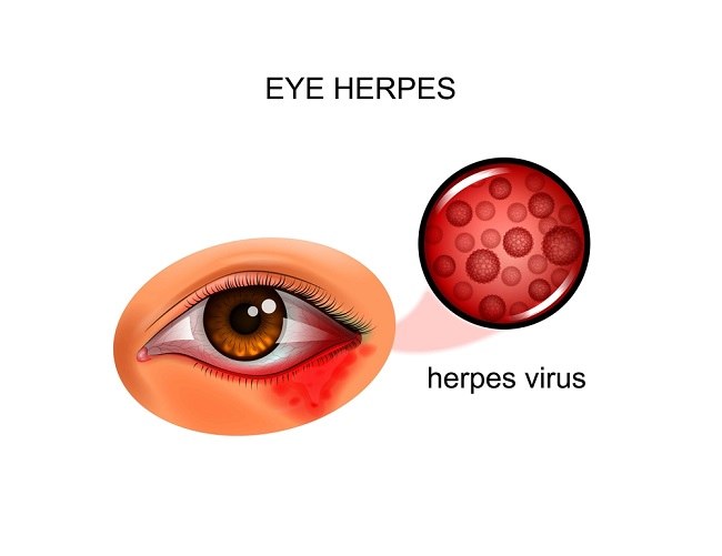 Recognize Symptoms of Herpes in the Eyes and Treatment