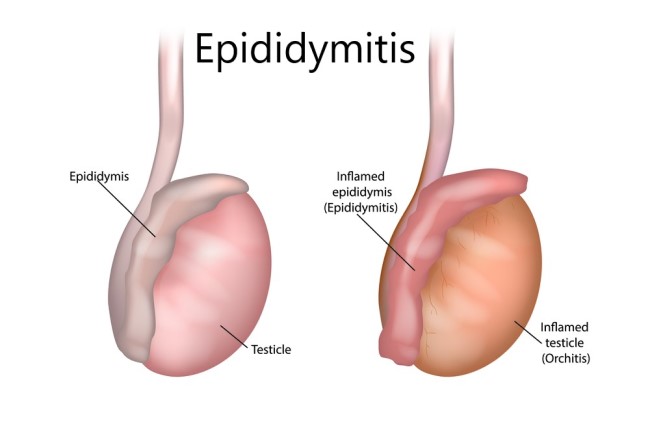 Diagnosis Epididimitis Alomedika 1292