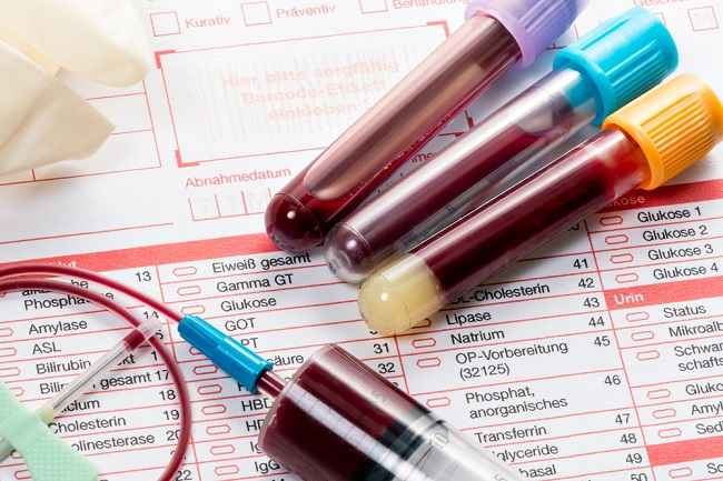 Pemeriksaan HbA1c untuk Mendeteksi dan Mengontrol Diabetes