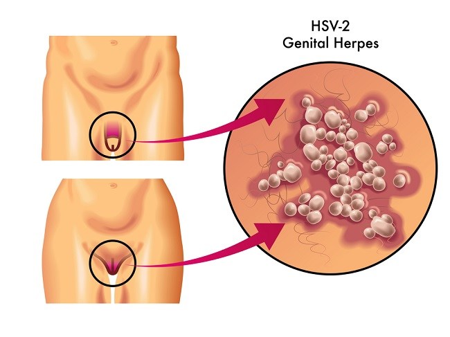 Edukasi Dan Promosi Kesehatan Herpes Simpleks Alomedika