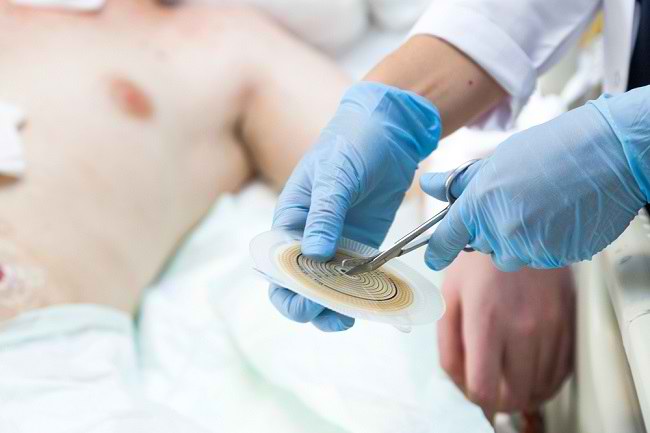 irigarea colonului prin stoma tratament cu paraziți orali