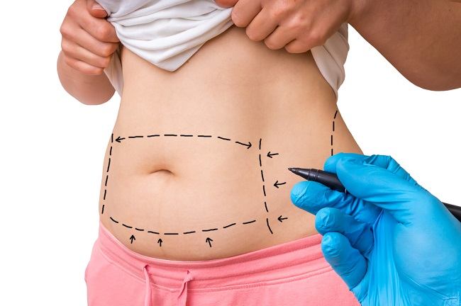 Mengenal Manfaat Dan Risiko Tummy Tuck Alodokter