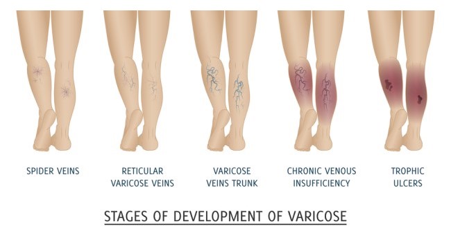 progresiva varicoza despre diagnosticul varicelor