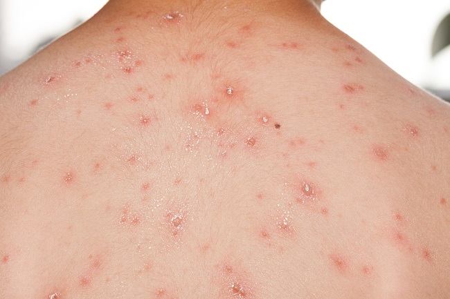 Monkey Smallpox: Symptoms and Ways to Prevent This Disease