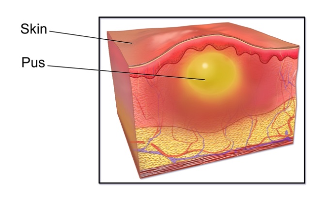 Furunkel Hidung - patofisiologi, diagnosis, penatalaksanaan - Alomedika