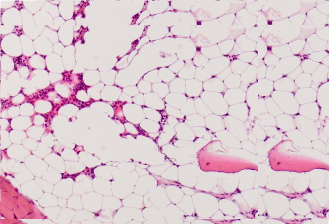 Diagnosis Anemia Aplastik - Alomedika