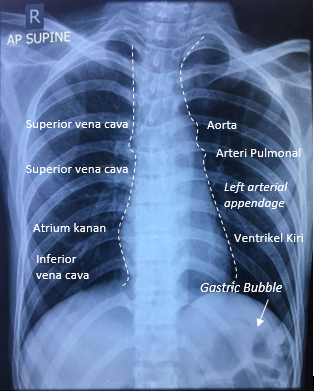 Contoh rontgen toraks dan bagian jantung berdasarkan siluet jantung. Sumber: dr. Immanuela, 2018.