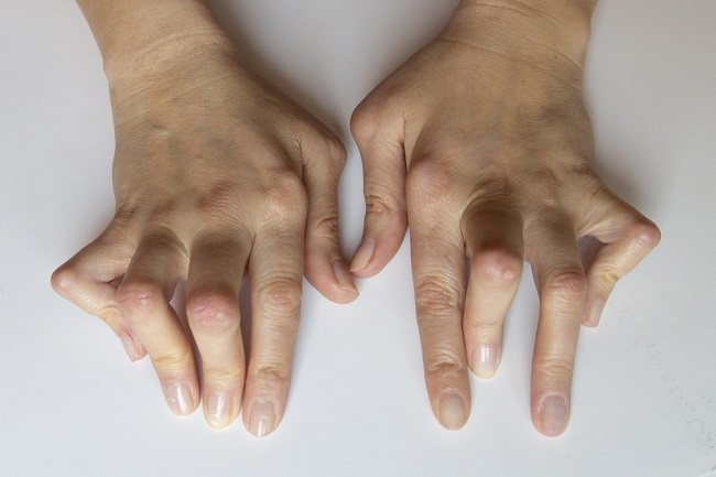 Recognize the Causes and Symptoms of Marfan Syndrome