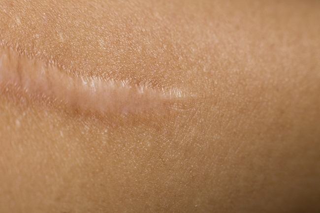 What Is Keloid and How to Overcome It?