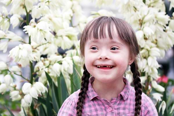 Williams Syndrome Gejala Penyebab Dan Mengobati Alodokter