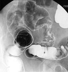 Barium enema kontras ganda: tampak gambaran shouldering atau apple core pada intralumen kolon sigmoid (tampak lumen menyempit)