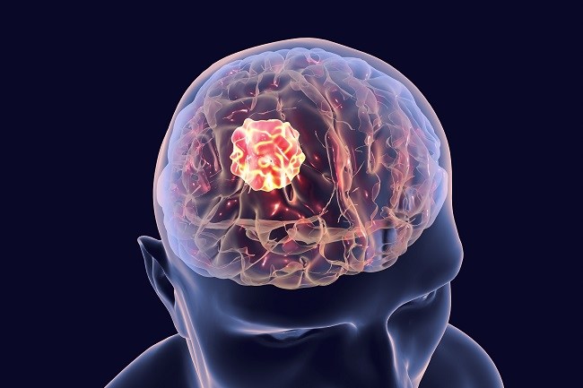 Patofisiologi Tumor Otak Alomedika