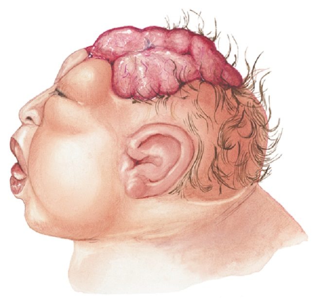 Diagnosis Neural Tube Defect Alomedika