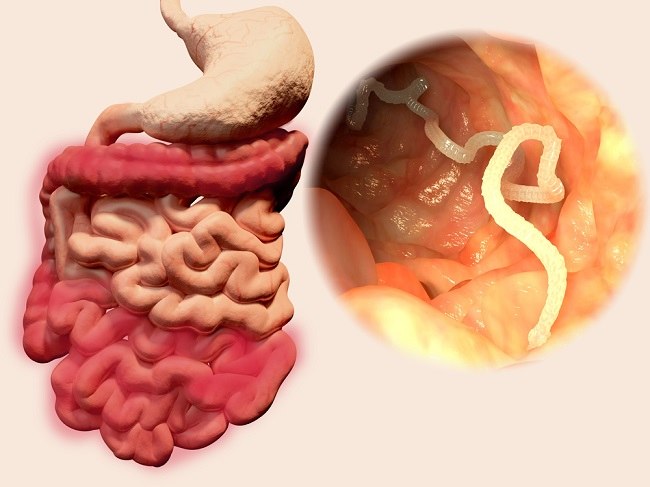 Taeniasis Patofisiologi Diagnosis Penatalaksanaan Alomedika 