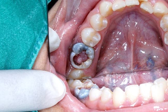 Polip Pulpa Gejala Penyebab Dan Mengobati Alodokter