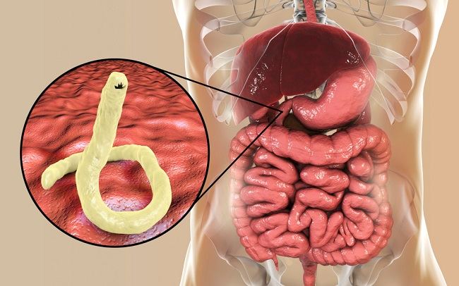 prevenirea infecțiilor helmintice il papilloma vescicale e maligno