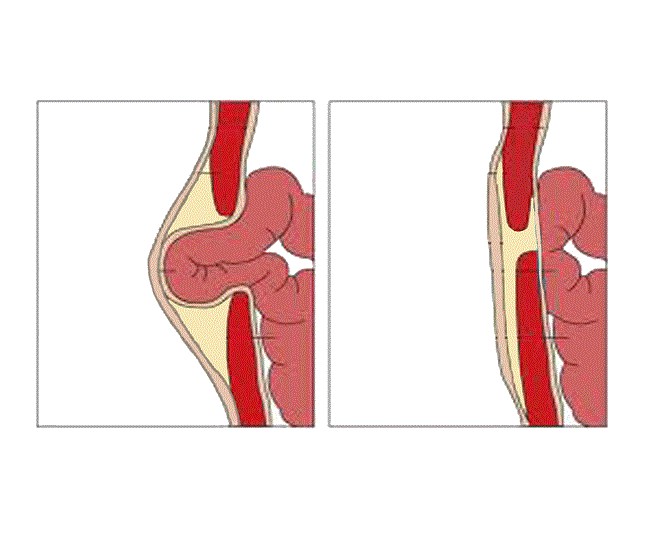 Hernia Umbilikalis Patofisiologi Diagnosis Penatalaksanaan Alomedika   609612 Alomedika 