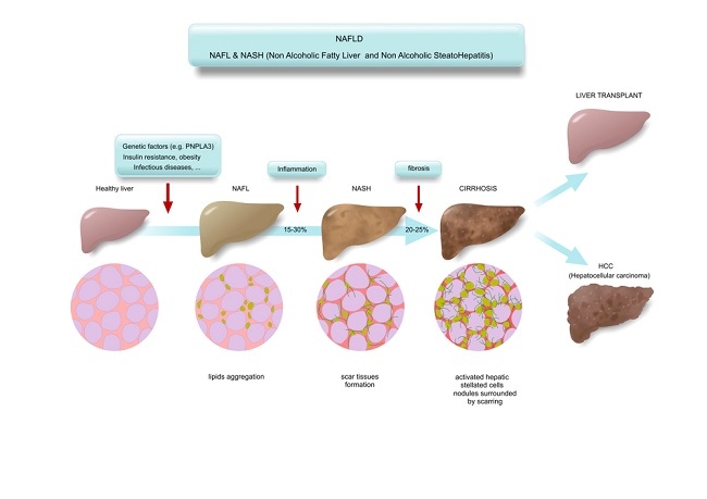 NAFLD NASH comp