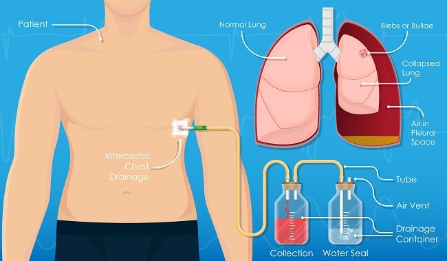 Penggunaan Chest  Tube Drainage VS Aspirasi Jarum Pada 