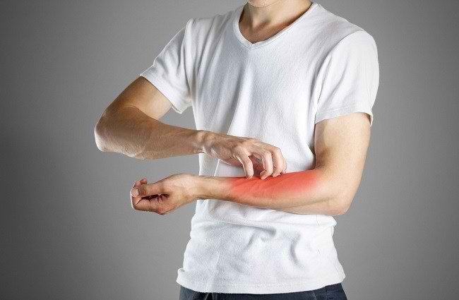 Causes of Wet Eczema and Treatments That Can Be Done at Home