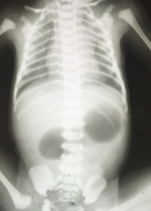 Diagnosis Atresia Intestinal - Alomedika