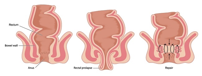 Diagnosis Prolaps Rektum - Alomedika