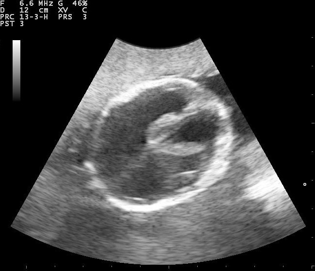 Gambar 2. Gambaran Ultrasonografi pada Fetus dengan Hydrocephalus. Sumber: Nevit Dilmen, Wikimedia commons, 2010