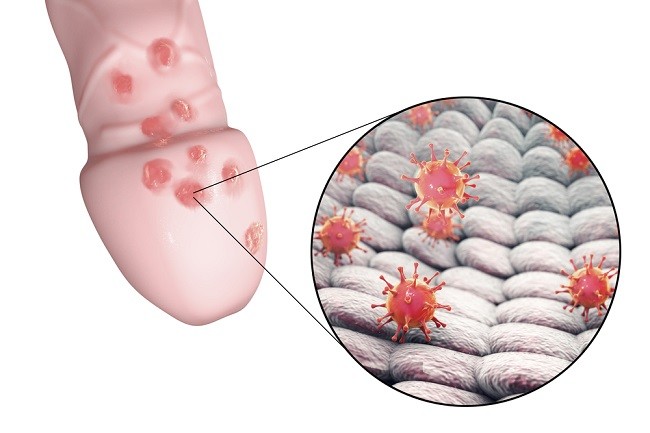 Edukasi Dan Promosi Kesehatan Herpes Genital Alomedika