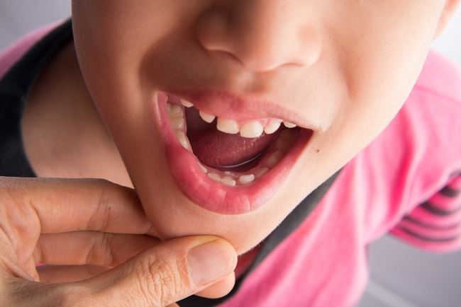 Milk Teeth in Children, Growth Process and How to Care for Them