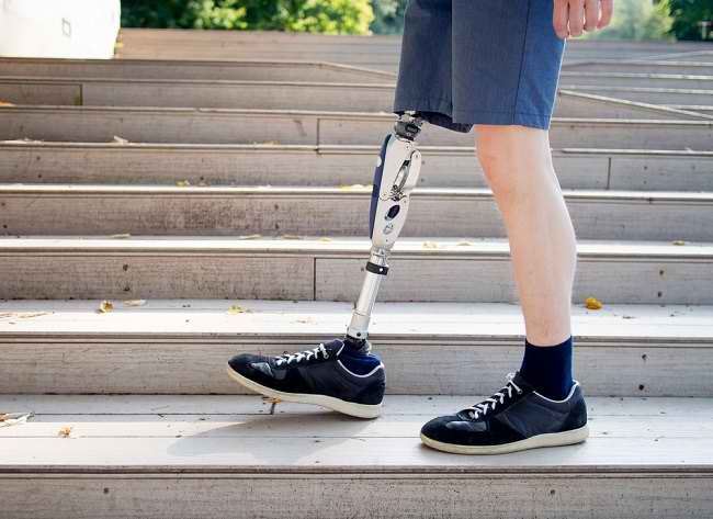 Recognize the Causes and Ways to Overcome Phantom Limb Syndrome