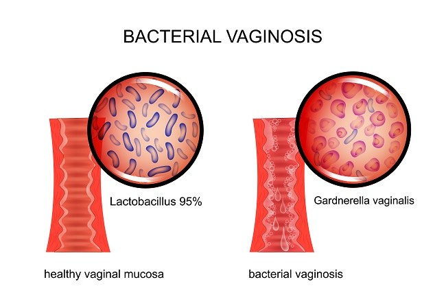 Penatalaksanaan Bakterial Vaginosis Alomedika