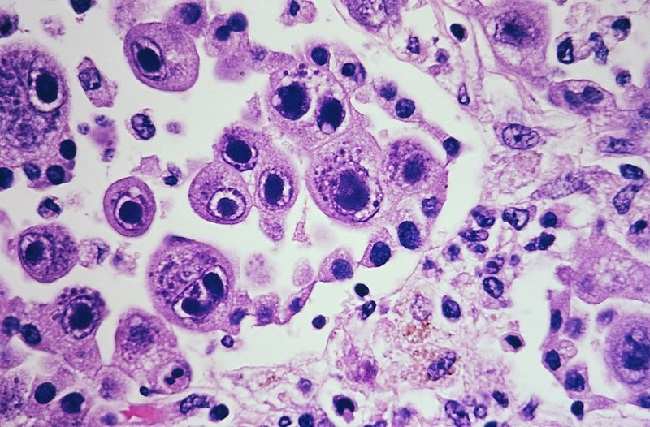 Infeksi CMV - patofisiologi, diagnosis, penatalaksanaan - Alomedika