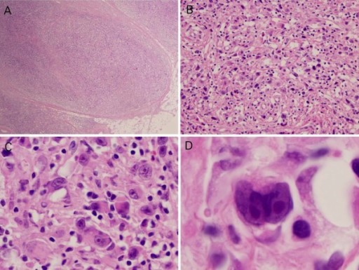 Gambar 1. Gambaran histopatologi limfoma maligna. (A) Gambaran karsinoma berdiferensiasi buruk; (B) Pewarnaan H&E menunjukkan gambaran limfosit kecil dan sejumlah sel Reed Sternberg (RS) berukuran besar; (C) Sel RS positif CD30; (D) Gambaran histopatologi ini mengesankan subtipe lymphocyte depleted. Sumber Gambar: Openi, 2012.