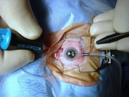 Gambar 1. Gambaran teknik prosedur vitrektomi. Sumber Gambar: Brod, Roy. Surgery for Diseases of the Vitreous and Retina. The Journal of Lancester General Hospital, Spring. 2009