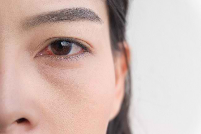Mengenal Penyebab Mata  Merah Alodokter