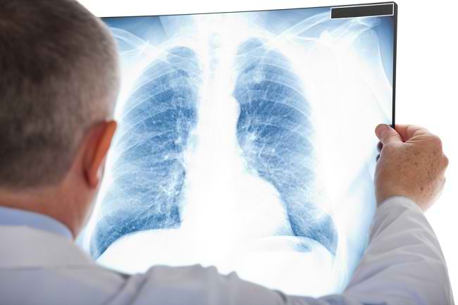 Know the Types of Pneumonia