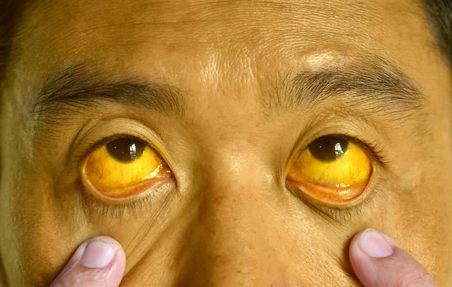 Varises esofagus alodokter