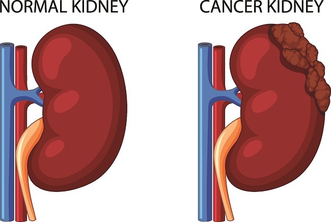 kanker ginjal - alodokter