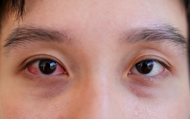 konjungtivitis - Alodokter