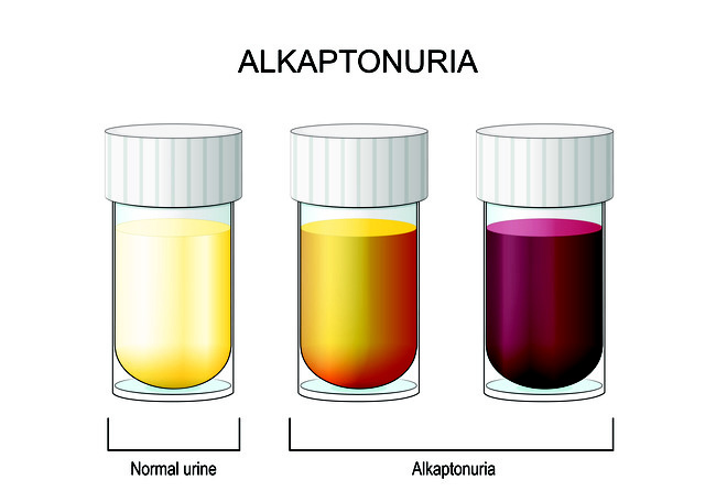 Alkaptonuria